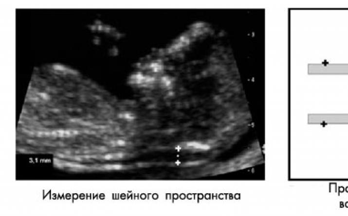 Пренатальный скрининг трисомий II триместра беременности (тройной тест)